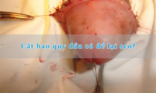 Cắt bao quy đầu có để lại sẹo?