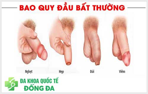 Bao quy đầu và các diện thường gặp