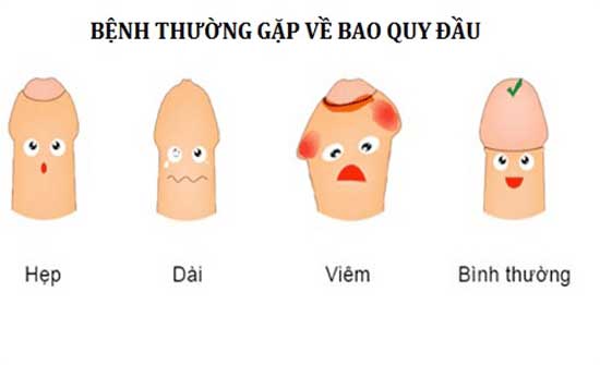 Diện bệnh bao quy đầu chính. Sẽ thế nào khi không được điều trị kịp thời