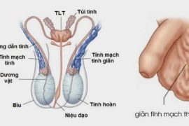 Phát hiện kịp thời và xử lý giãn tĩnh mạch thừng tinh