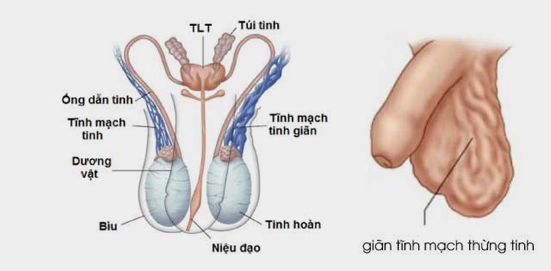 Phát hiện kịp thời và xử lý giãn tĩnh mạch thừng tinh