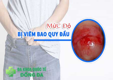 Mức độ viêm bao quy đầu như thế nào là nguy hiểm?