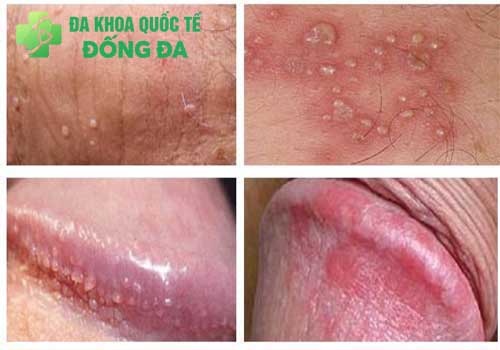 muc-do-viem-bao-quy-dau
