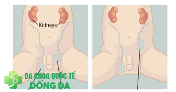 Hướng điều trị tinh hoàn ẩn ở trẻ em