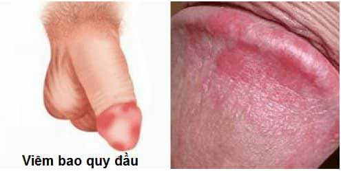 viem-bao-quy-dau-nam