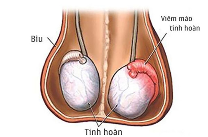 viem-tinh-hoan