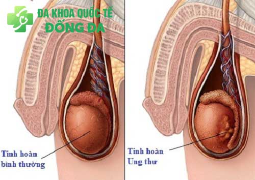 Viêm mào tinh hoàn có phải một dạng ung thư?