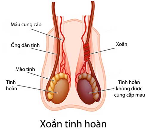 xoan-tinh-hoan-benh-ly-tinh-hoan