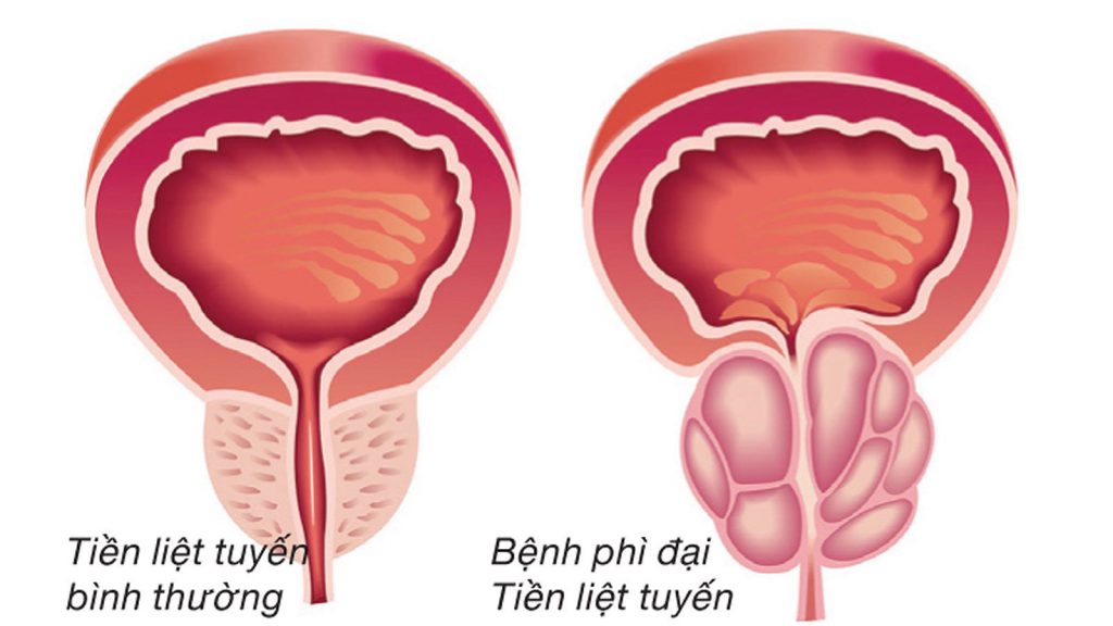 benh-phi-dai-tien-liet-tuyen-va-dieu-tri