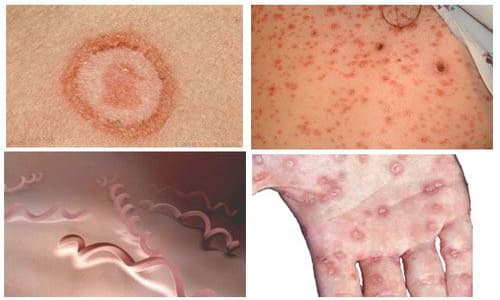 benh-giang-mai-co-giong-hiv