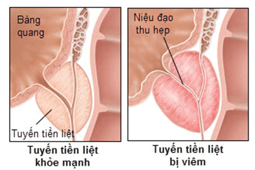 dieu-tri-viem-tuyen-tien-liet