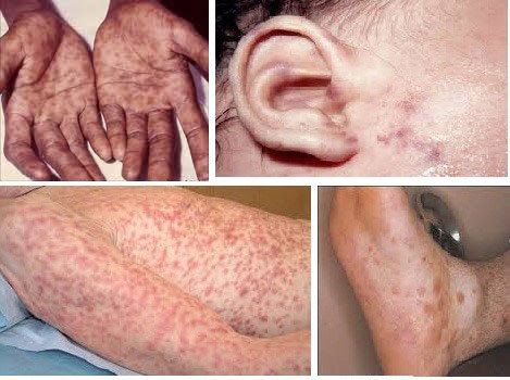 giang mai HIV