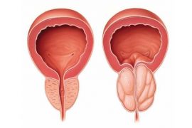 U nang tuyến tiền liệt có phải một dạng ung thư?