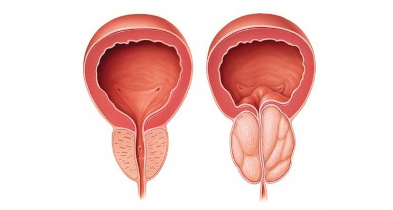 U nang tuyến tiền liệt có phải một dạng ung thư?