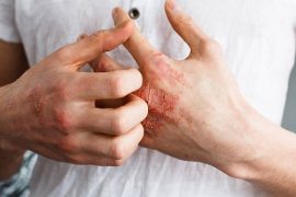Bệnh giang mai có giống với HIV