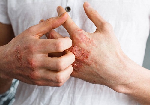 Bệnh giang mai có giống với HIV