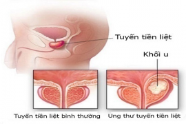 Phì đại tiền liệt tuyến có phải là ung thư?