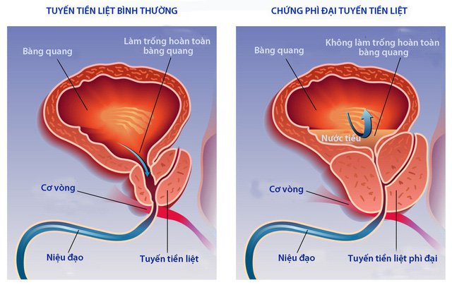 phì đại tiền liệt tuyến