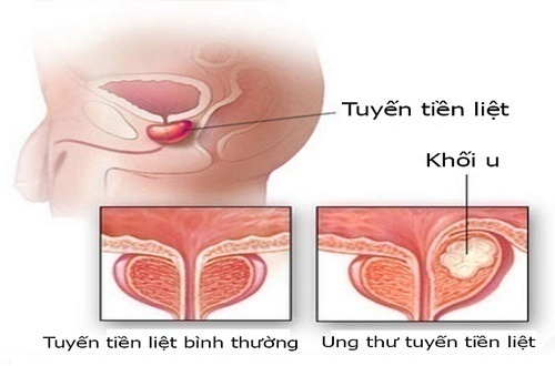 Phì đại tiền liệt tuyến có phải là ung thư?