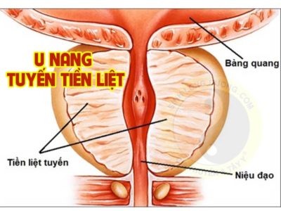 u nang tiền liệt tuyến