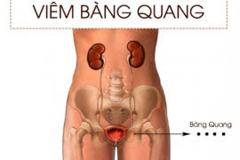 Cảnh báo viêm bàng quang ở nữ giới
