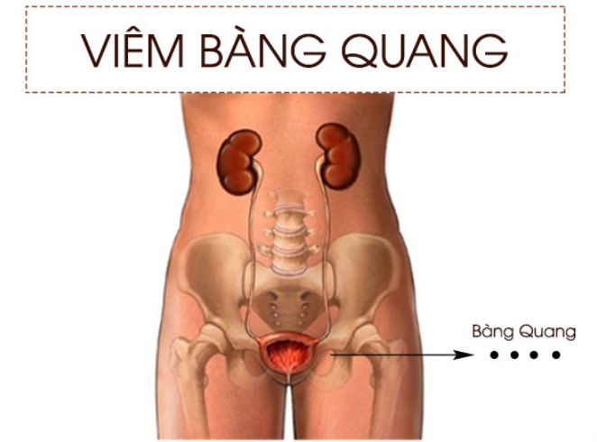 Cảnh báo viêm bàng quang ở nữ giới