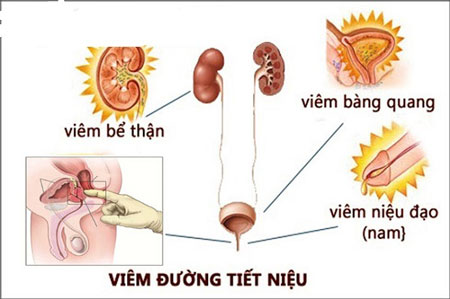 Tiểu rắt dẫn đến viêm đường tiết niệu